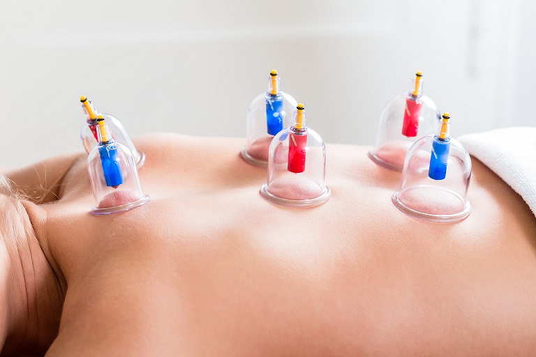 Ventouse  cupping